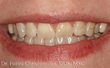 tooth #4 before dental service actual patient