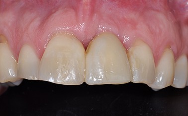 tooth dental case before photo