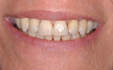 tooth dental case before photo