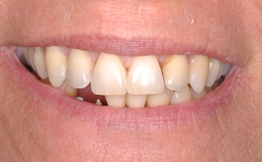 tooth dental case before photo