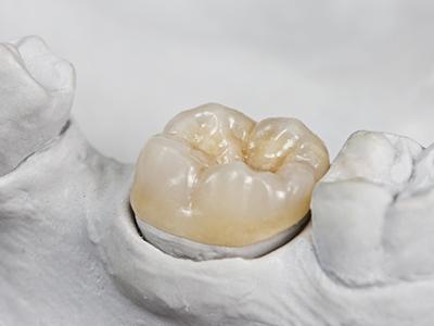 Model smile with dental crown