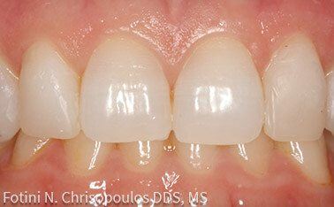 tooth #24 after dental service actual patient