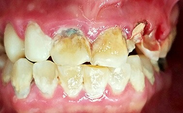 tooth #11 before dental service actual patient