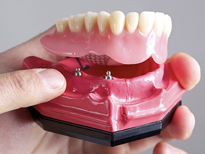 hand holding implant-assisted dentures (i.e., overdenture)