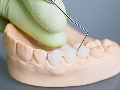 dental bridge on a gum structure model