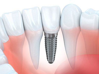 single tooth implant model