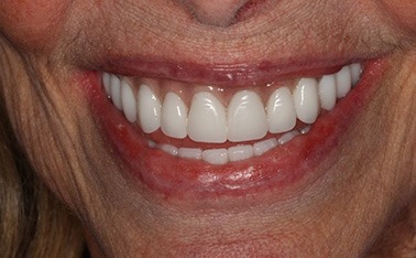 Patient with flawless smile after prosthodontic treatment