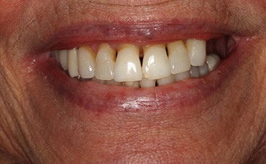 Patient before prosthodontic treatment
