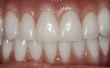 Closeup of beautiful, healthy smile after treatment