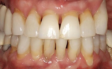 Closeup of damaged and decayed teeth and gums before treatment