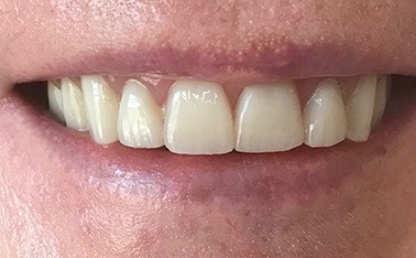Flawlessly repaired front teeth