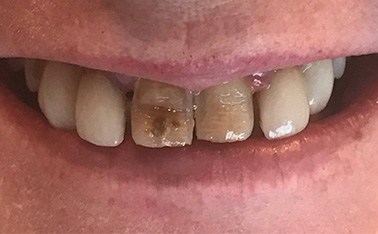 Severely decayed and discolored front teeth
