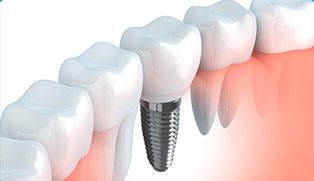 Tysons dental implants and crown model