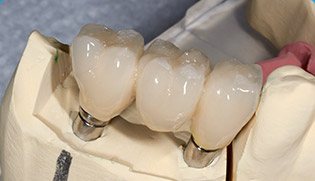 dental bridge model