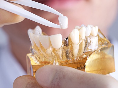 dental implant model