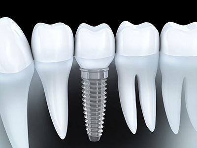 dental crown on the implant model