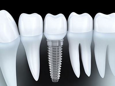 dental crown on the implant model