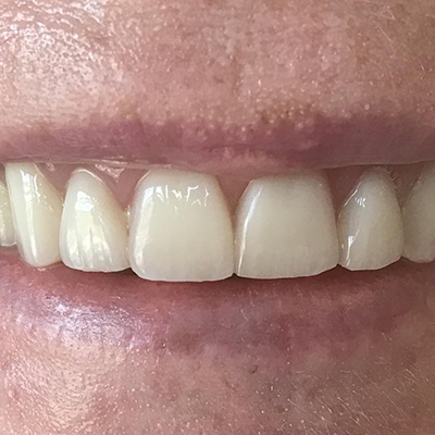 Closeup of flawlessly repaired smile