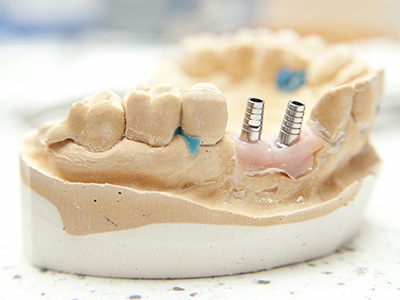 dental implant anchor model