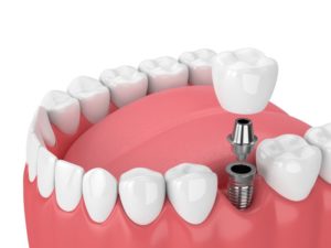 a dental implant