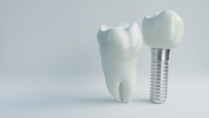 a tooth and a dental implant