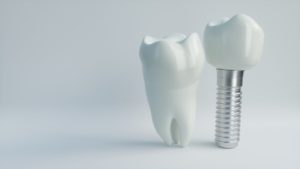 a tooth and a dental implant